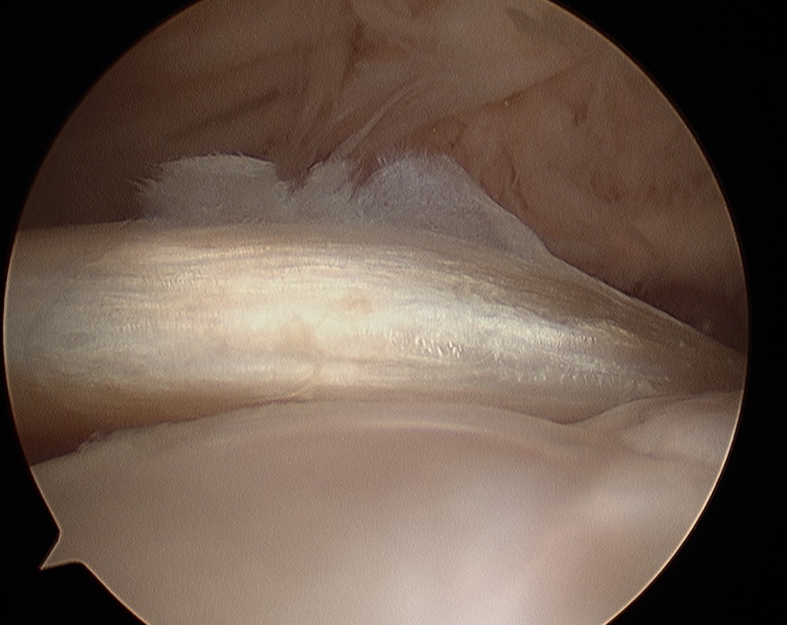 Biceps Tendonopathy Grade 2 Arthroscopy